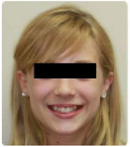 braces before