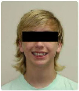 braces before
