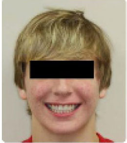 braces after