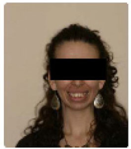 before getting braces