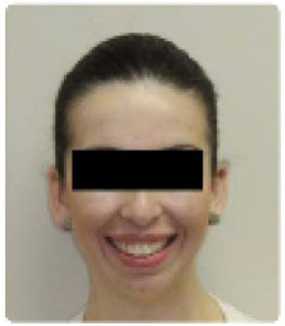 after getting braces