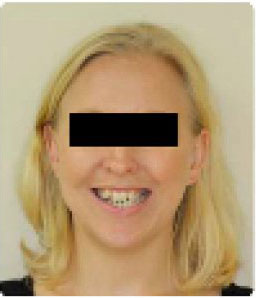 before getting braces
